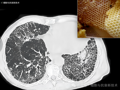 外泌体雾化可治疗肺部结节及肺纤维化